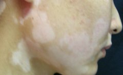 腿部出现白斑有哪些原因呢