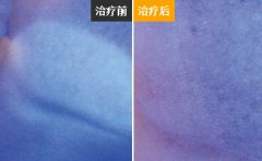 白癜风治疗饮食方面需要注意什么